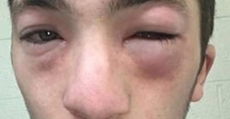 University Student With Peanut Allergy Was Hazed With Peanut Butter, Mom Says